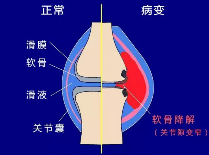 膝盖缺痛跑步后不痛了_跑步后膝盖痛缺什么_膝盖跑步后疼痛需不需要治疗