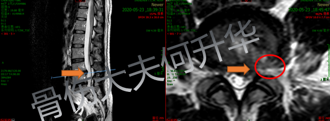 腰椎间盘突出能扭腰吗_腰椎间盘突出扭腰好吗_椎间盘突出扭腰