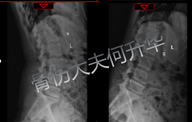 椎间盘突出扭腰_腰椎间盘突出扭腰好吗_腰椎间盘突出能扭腰吗