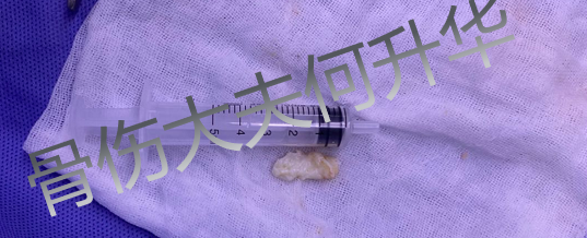 腰椎间盘突出能扭腰吗_腰椎间盘突出扭腰好吗_椎间盘突出扭腰