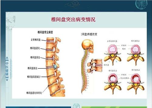 腰椎间盘突出 运动_腰椎间盘突出运动_突出腰椎盘间运动能治好吗