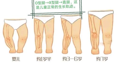 小孩小腿弯曲的正常图_腿弯的小孩_儿童腿弯矫正