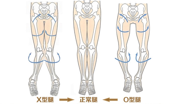 小孩小腿弯曲的正常图_儿童腿弯矫正_腿弯的小孩