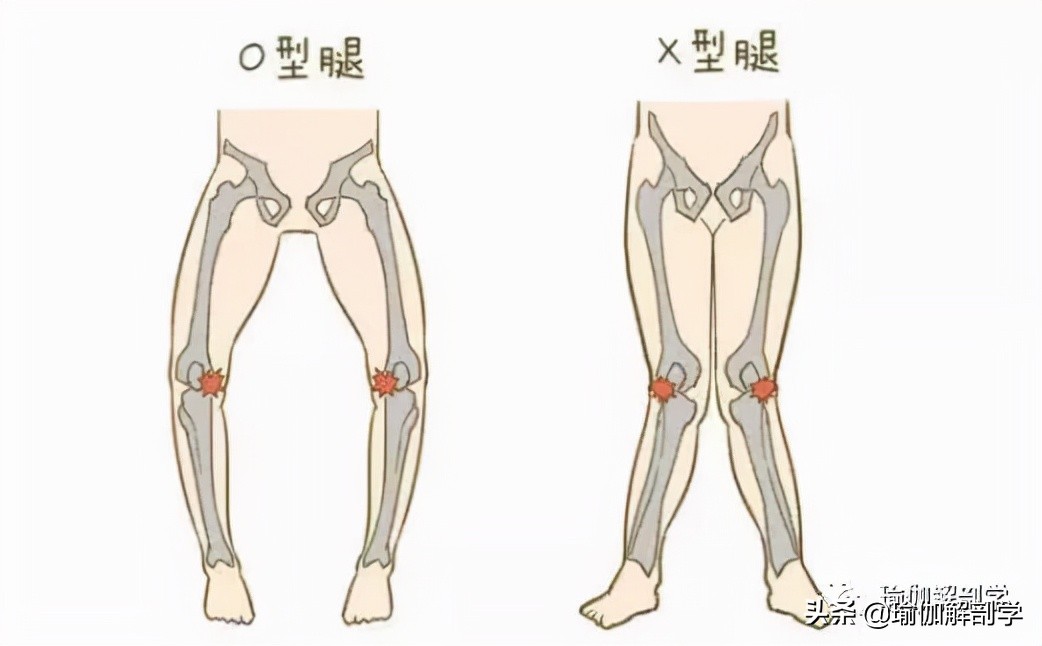 瑜伽腿型矫正_瑜伽能改善腿形吗_改善x型腿的瑜伽