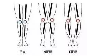 改善x型腿的瑜伽_瑜伽改善腿型动作_瑜伽腿型矫正